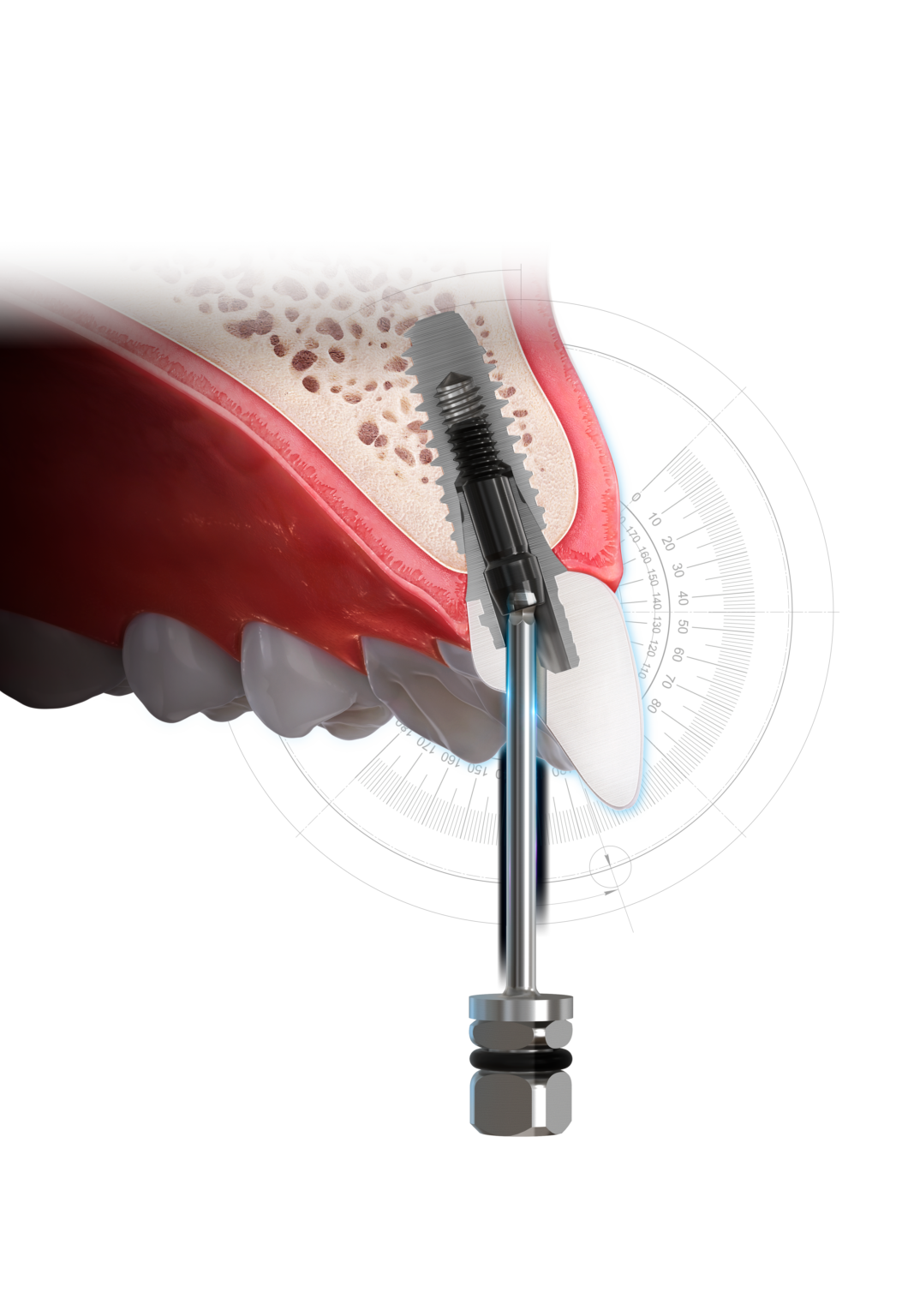 Kit Prot Sico Hiossen Implant