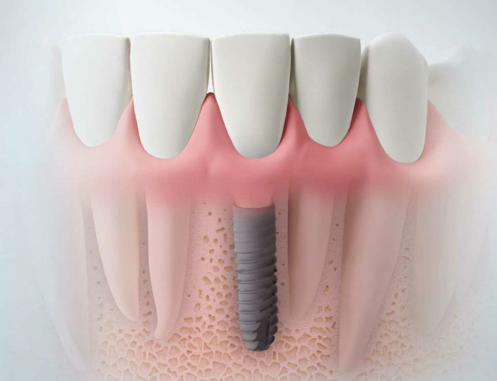 Platform Switching for Dental Implants | Hiossen® Implant