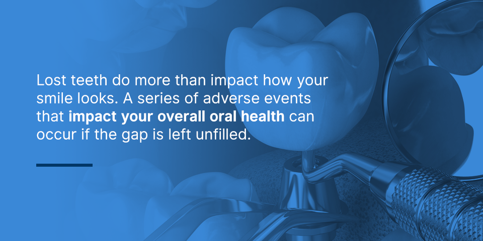  Negative Side Effects of Tooth Loss
