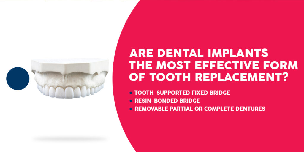 Are Dental Implants the Most Effective Form of Tooth Replacement?