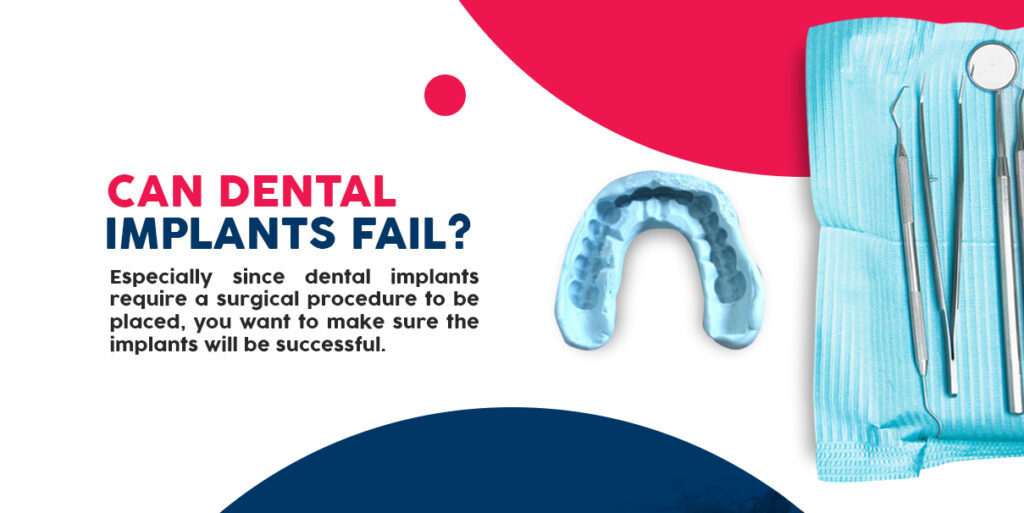 Can Dental Implants Fail?