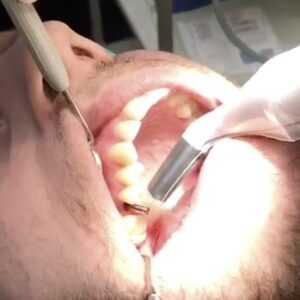 Dental implant placement