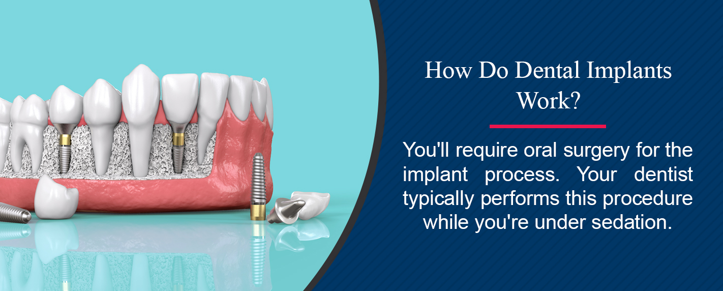 Dental Bridges Vs Dental Implants Hiossen® Implant 