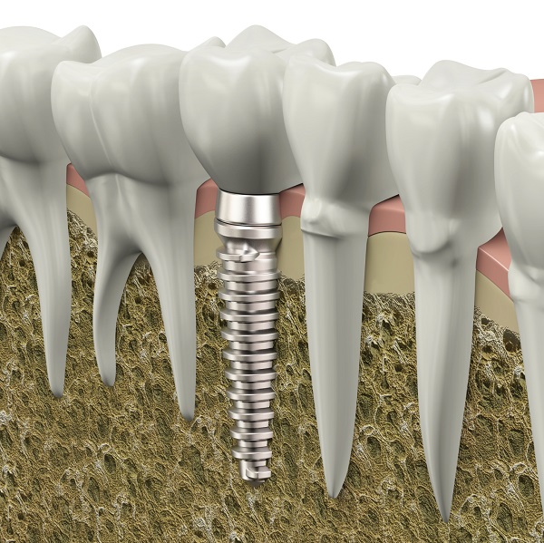 Full Mouth Dental Implants - ClearChoice