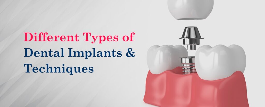 A Guide to Different Types of Dental Implants & Techniques