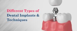 Different Types Of Dental Implants & Techniques