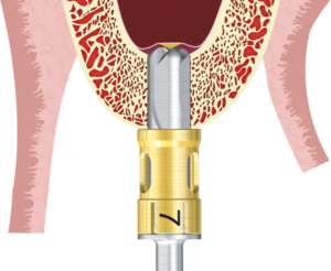 Sinus Lift equipment for dental implants