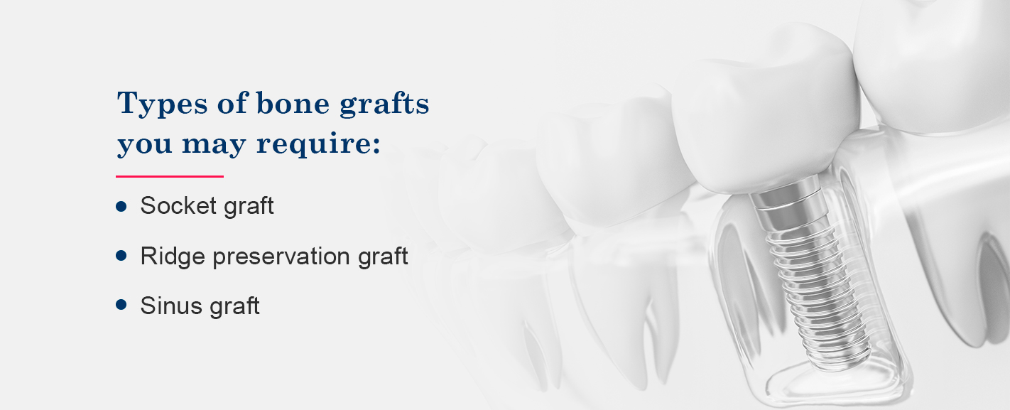 Types on bone grafts