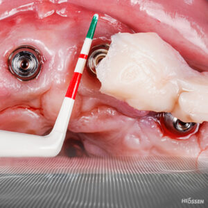 Soft Tissue grafting for a dental implant