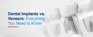 Dental-implants-vs-veneers-everything-you-need-to-know