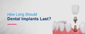 How Long Should Dental Implants Last