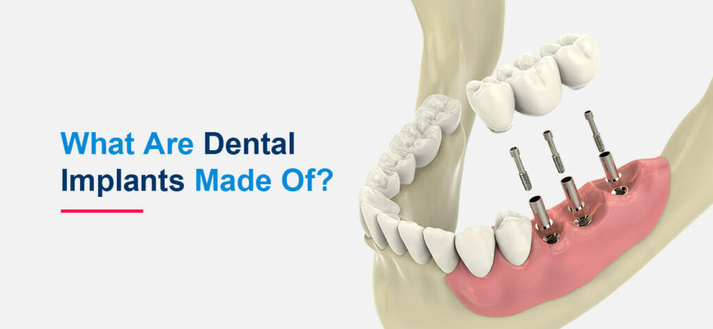 what-are-dental-implants-made-of-hiossen