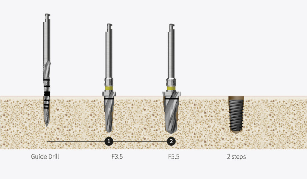 122 Taper Kit Hiossen® Implant