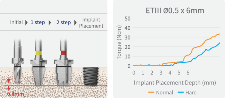 485 Kit - Hiossen® Implant