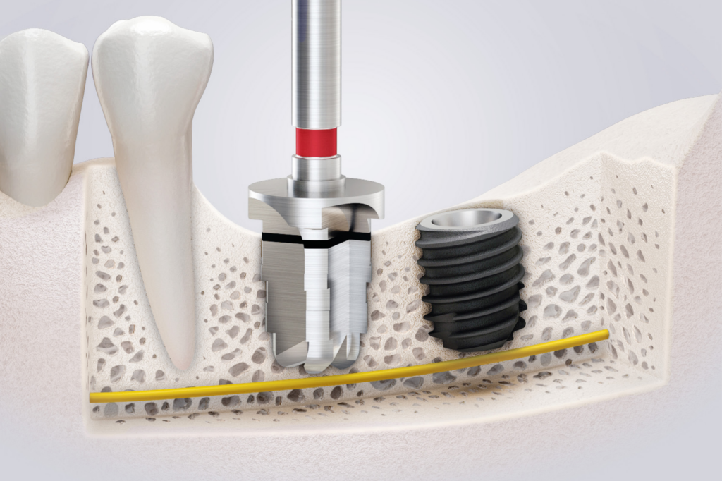 485 Kit - Hiossen® Implant