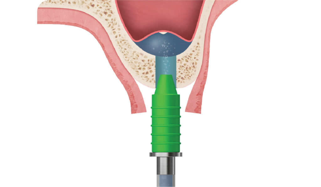 CAS Kit Hiossen® Implant