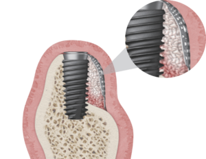 OssBuilder Kit - Hiossen® Implant