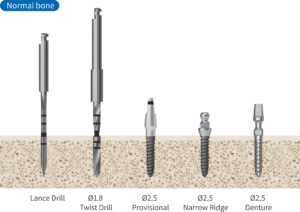 EM Kit - Hiossen® Implant
