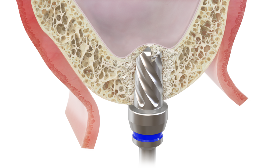 Bone Compaction Kit - Hiossen® Implant
