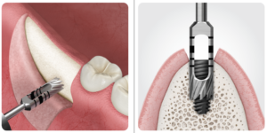 Bone Compaction Kit - Hiossen® Implant